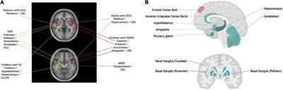 Enhancing neuroimaging genetics through meta-analysis for Tourette syndrome (ENIGMA-TS): A worldwide platform for collaboration